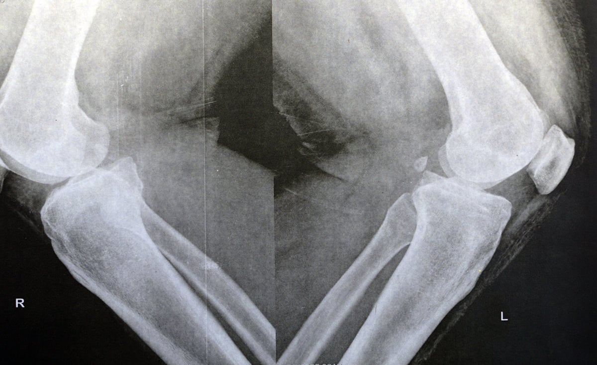 Radiografía de rodilla con signos de desgaste articular y estrechamiento del espacio articular