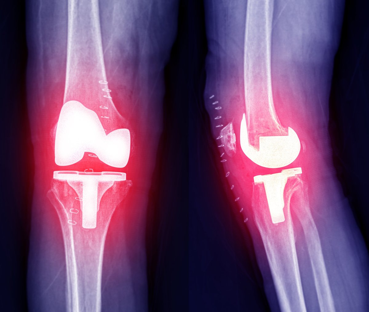 Vistas anterior y lateral de una articulación artificial de rodilla para referencia anatómica de los compartimentos