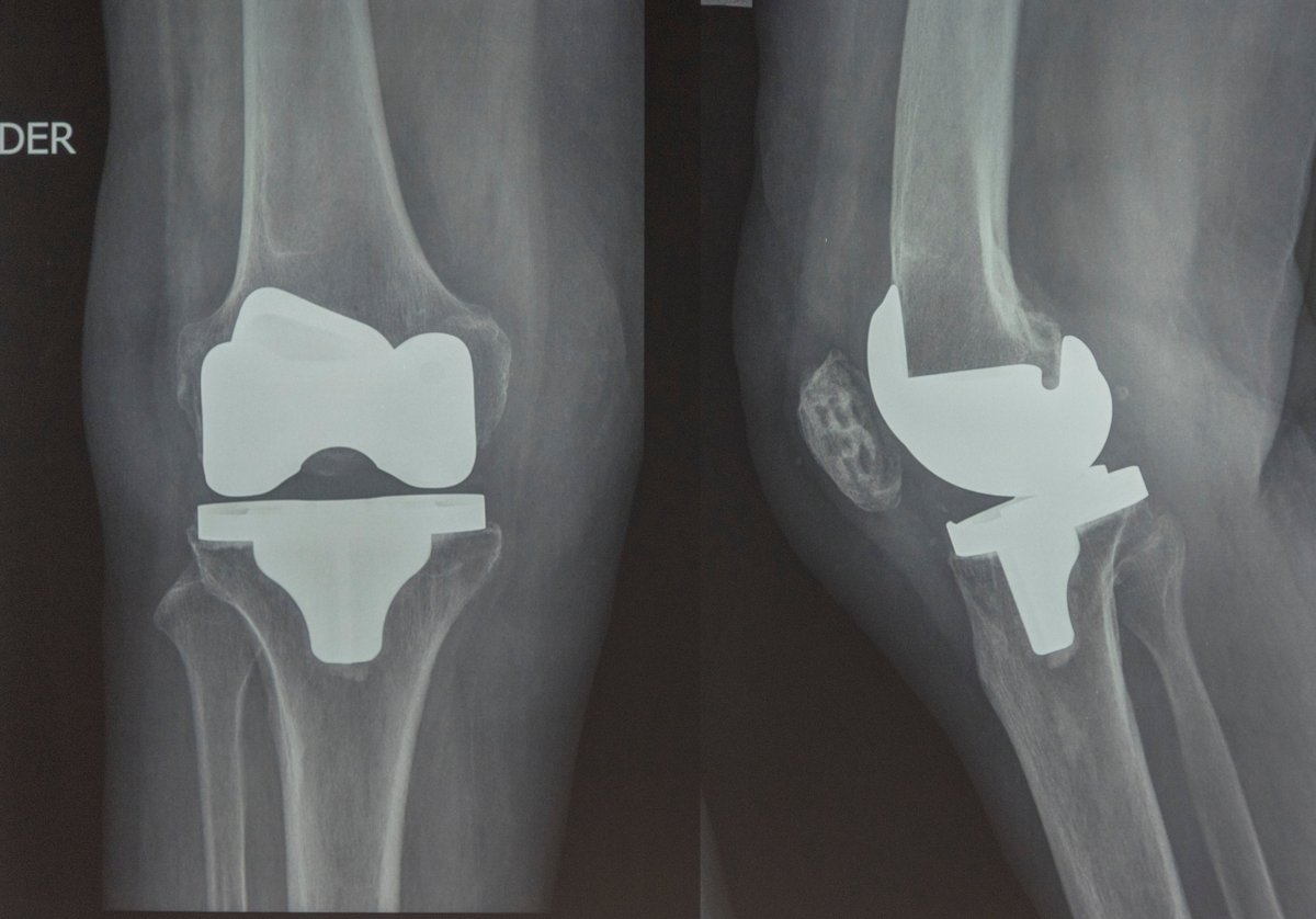 Radiografía de una rodilla con un reemplazo de rodilla que compromete un compartimento articular