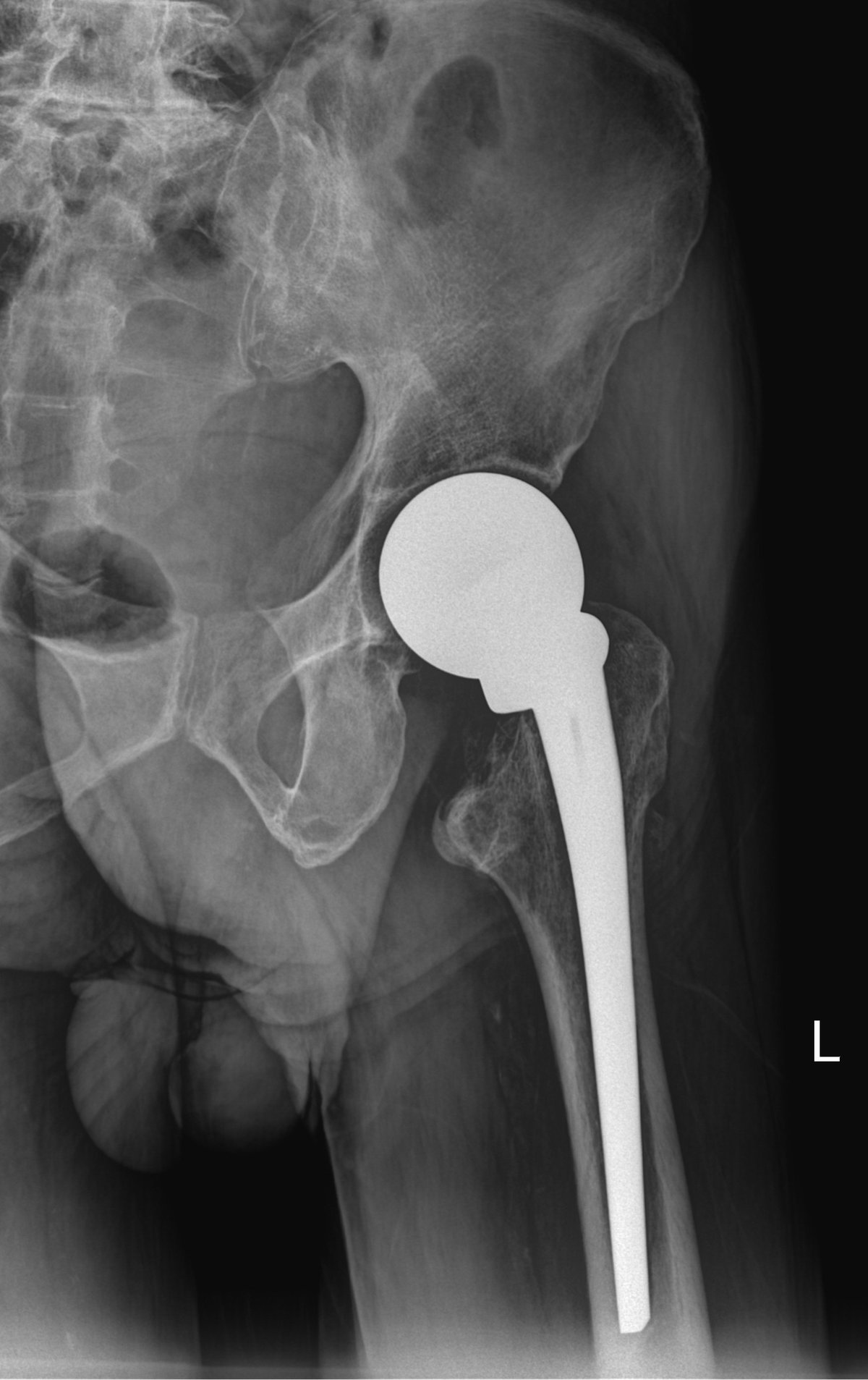 Radiografía de una cadera con prótesis de cadera, mostrando el implante que sustituye las superficies articulares