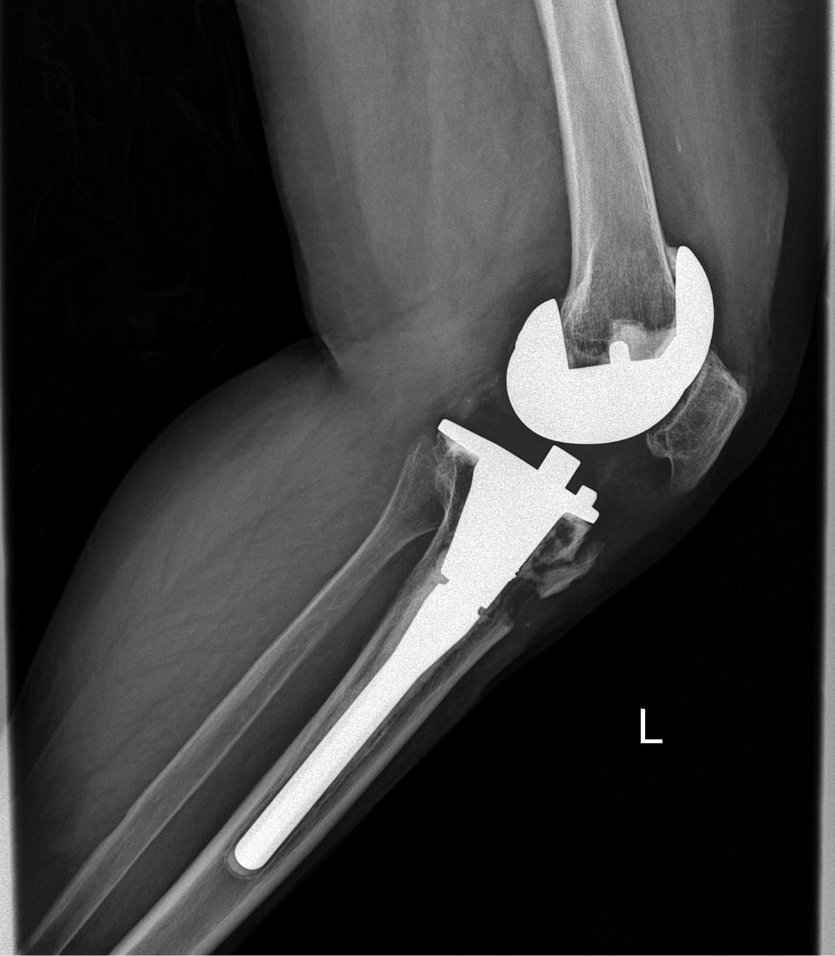 ¿Cuándo empieza a considerarse una prótesis de rodilla?