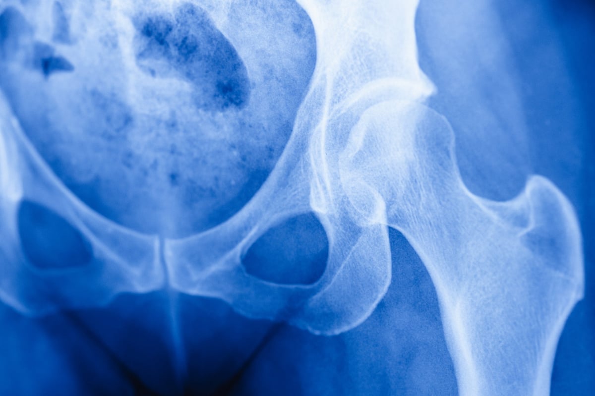 Radiografía de pelvis y fémur proximal