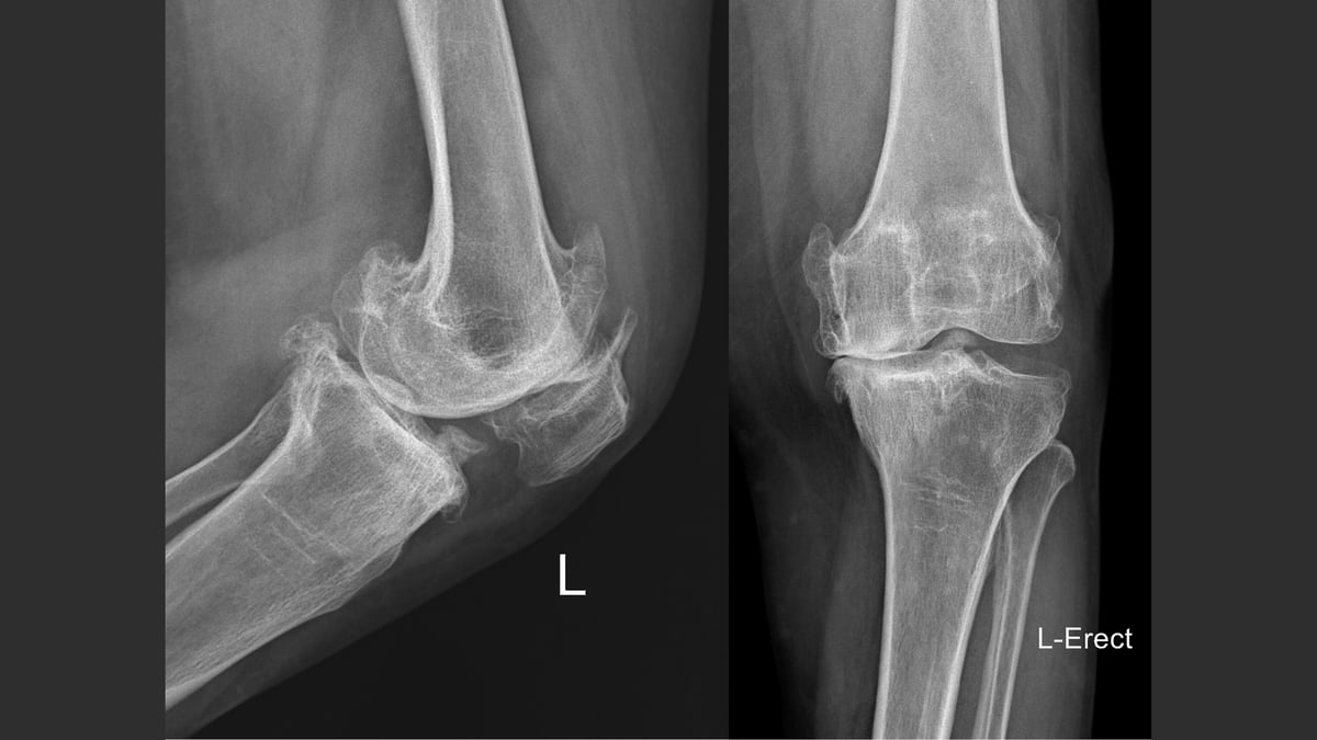 Radiografía anteroposterior y lateral de la rodilla que muestra la alineación y el espacio articular