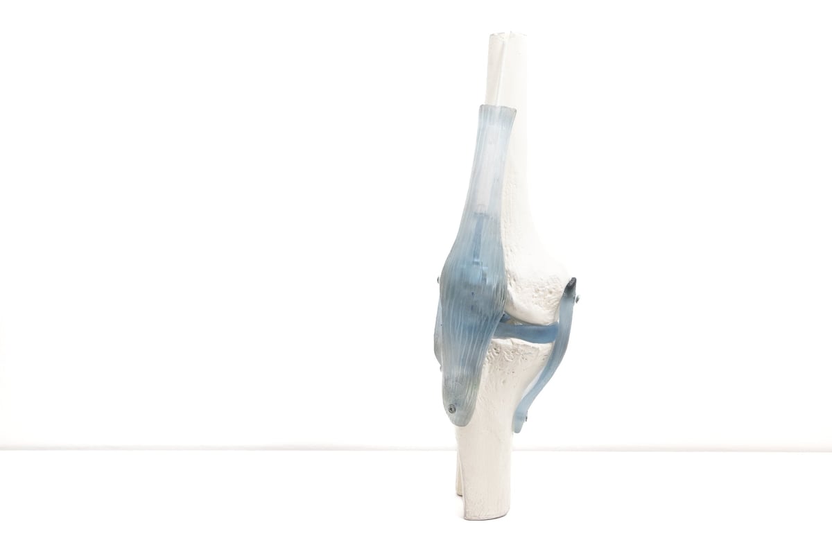 Lesión meniscal longitudinal orientada en paralelo al borde del menisco