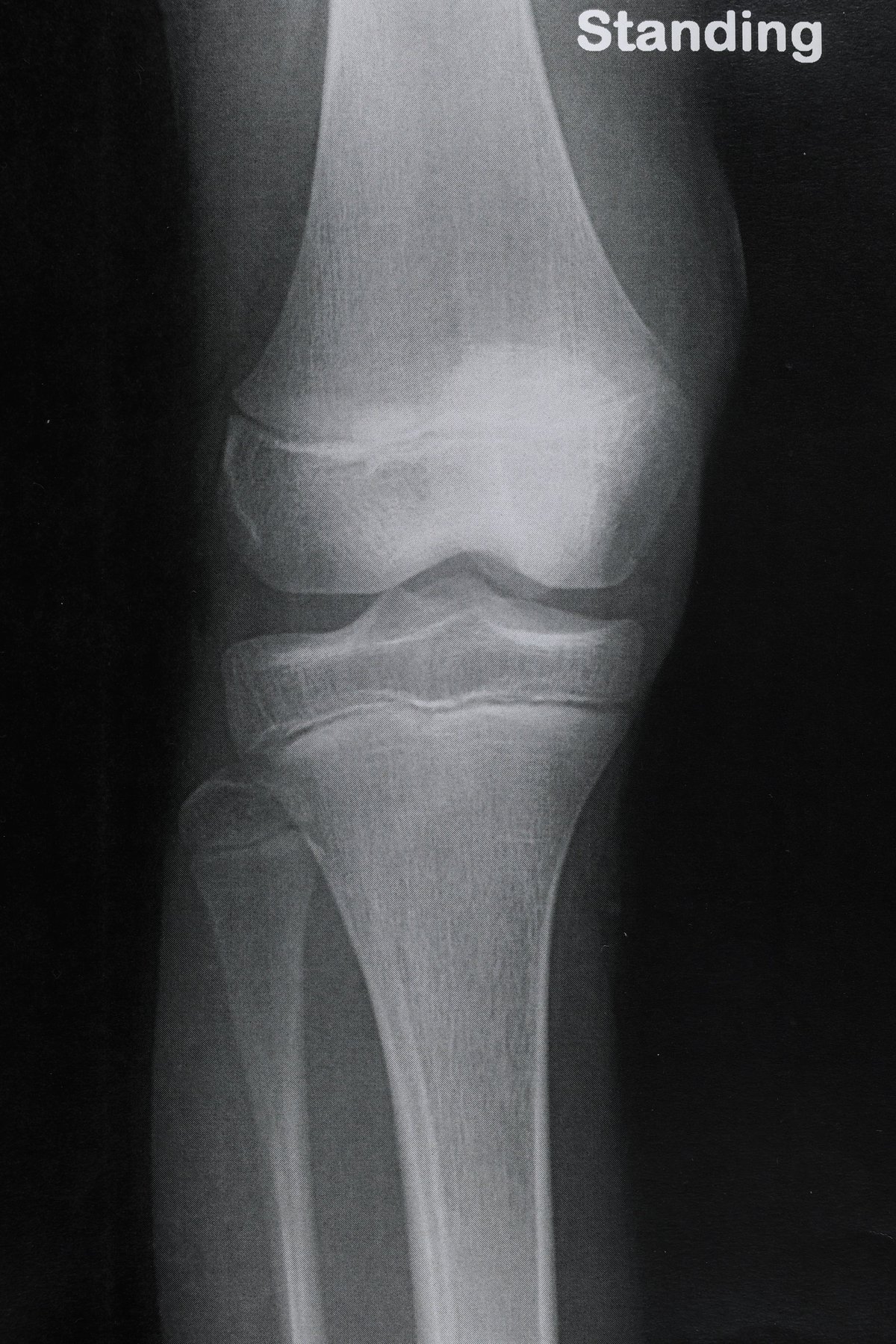 Estudio radiográfico de rodilla: hueso, cartílago, meniscos, ligamentos y superficies articulares