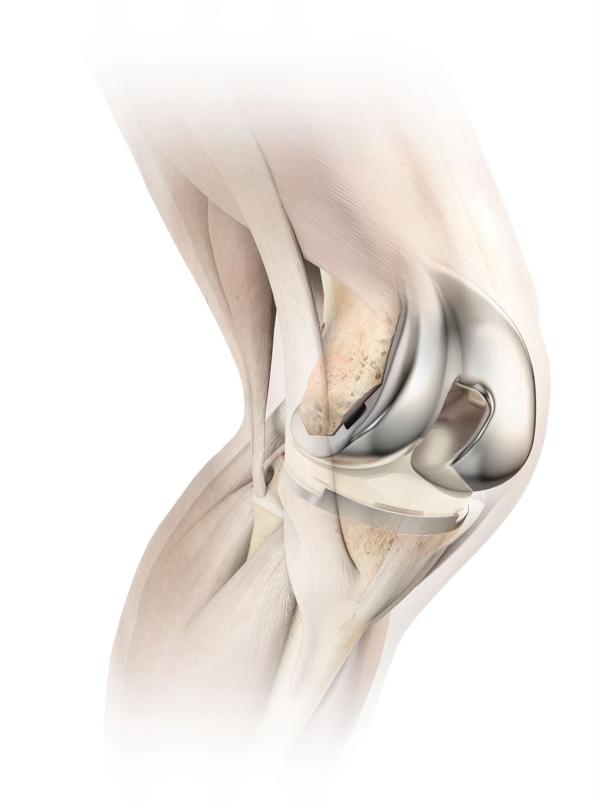 Reconstrucción articular de rodilla — modelo anatómico de precisión
