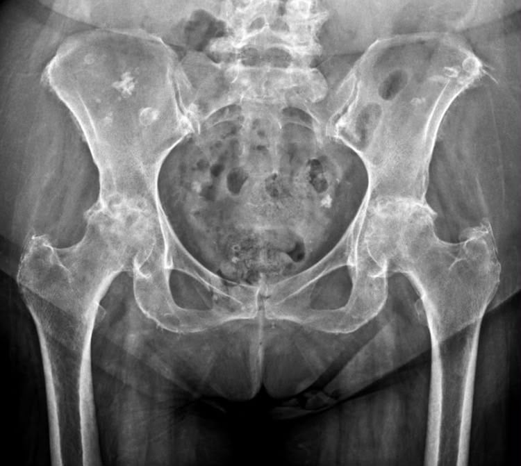 Radiografía AP de pelvis antes de la colocación de la prótesis de cadera
