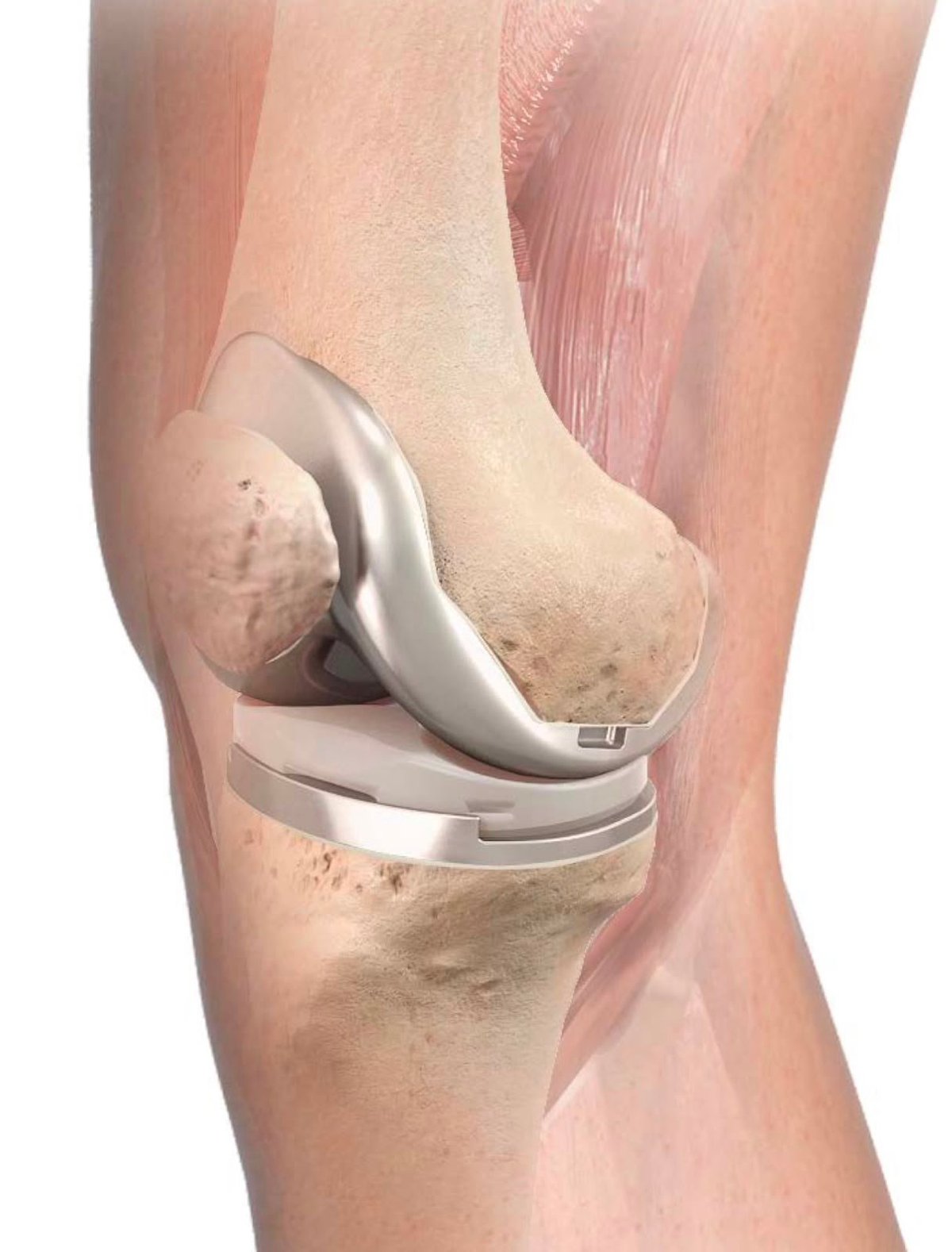 Reconstrucción 3D de una prótesis de rodilla colocada sobre la anatomía