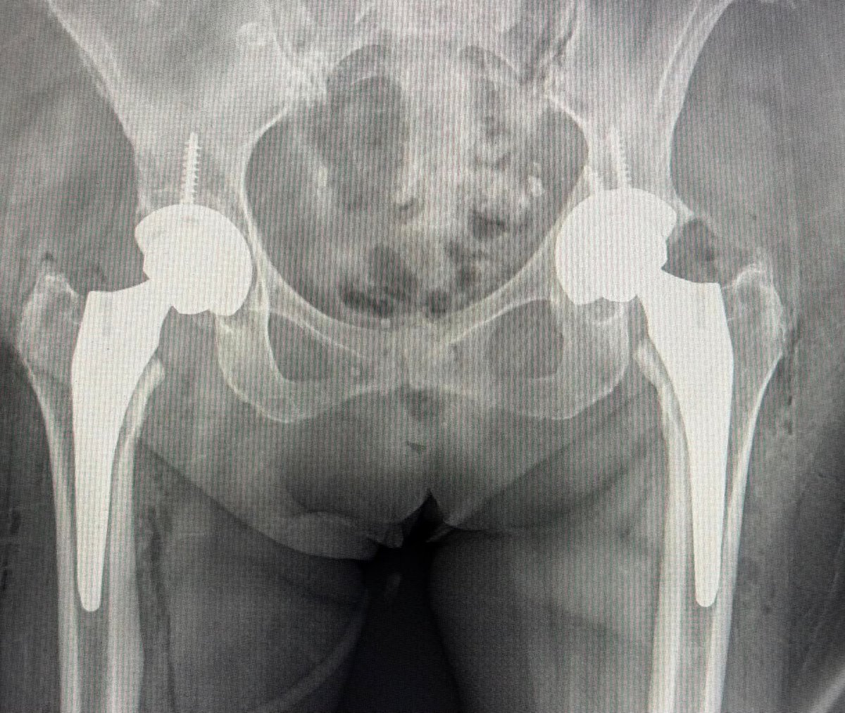 Radiografía AP de pelvis después de la colocación de prótesis bilateral de cadera
