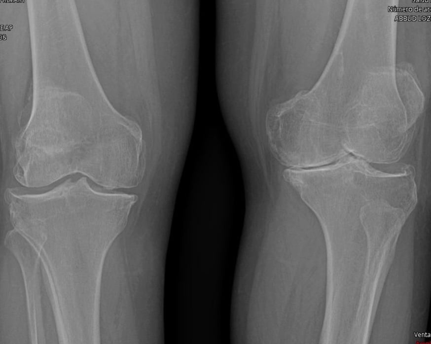 Radiografía AP de ambas rodillas con desgaste del espacio articular