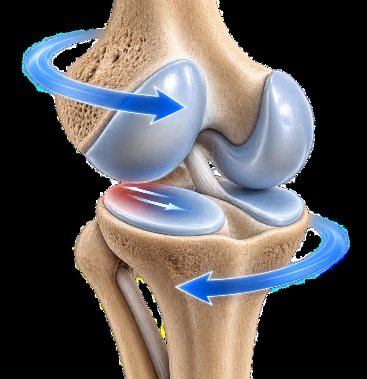 Ilustración anatómica de la rodilla con una flecha azul descendente que muestra la concentración de una fuerza de impacto directa sobre la superficie articular.