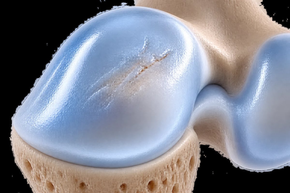 Close-up de cartílago articular azul translúcido sobre hueso, mostrando una irregularidad superficial leve con continuidad conservada.